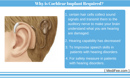 requirement of cochlear implant need of cochlear implant