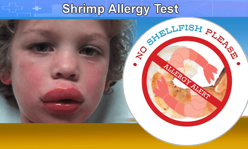 Image result for shrimp allergy
